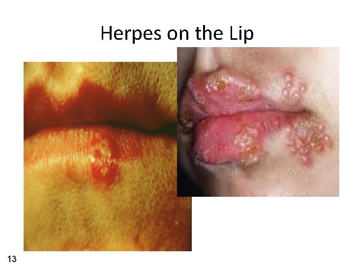 Herpes on the Lip 13 