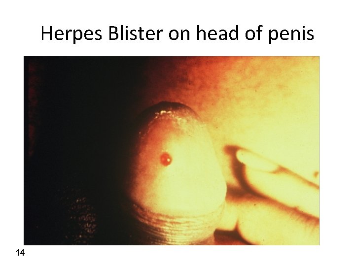 Herpes Blister on head of penis 14 