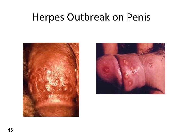 Herpes Outbreak on Penis 15 