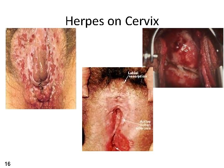 Herpes on Cervix 16 