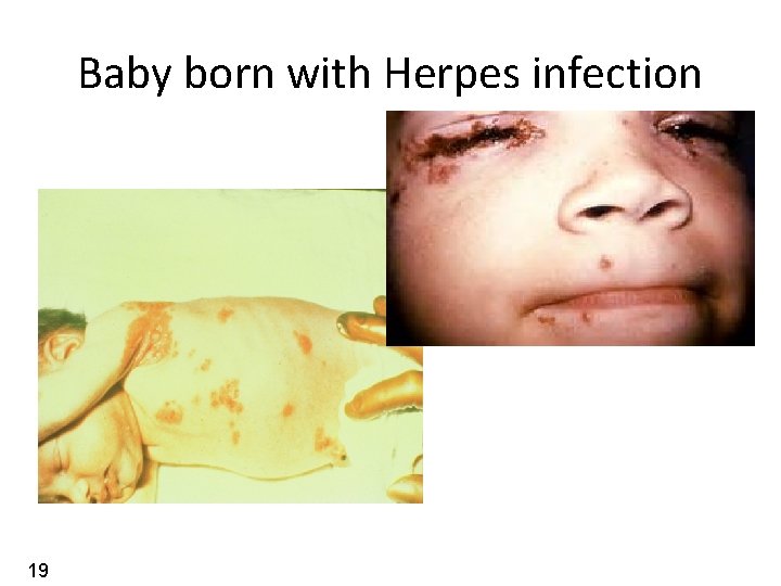 Baby born with Herpes infection 19 