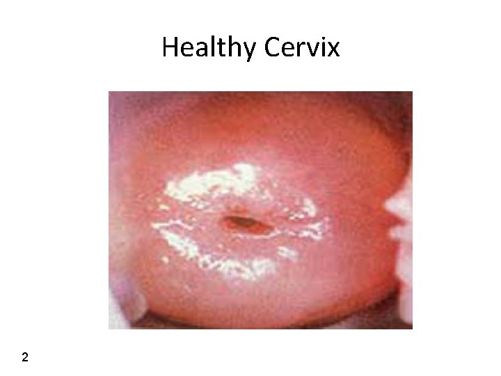 Healthy Cervix 2 