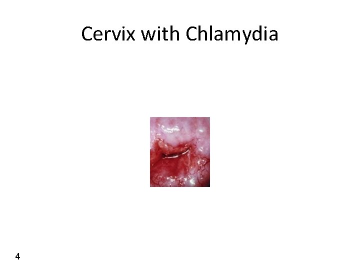 Cervix with Chlamydia 4 