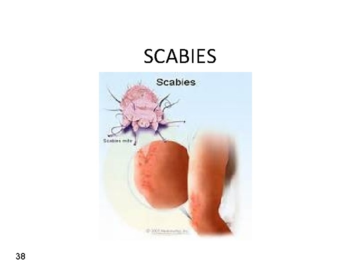 SCABIES 38 