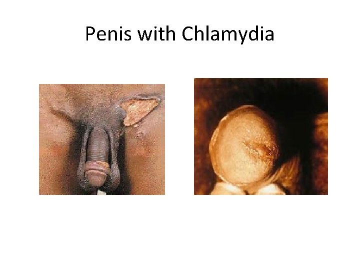 Penis with Chlamydia 