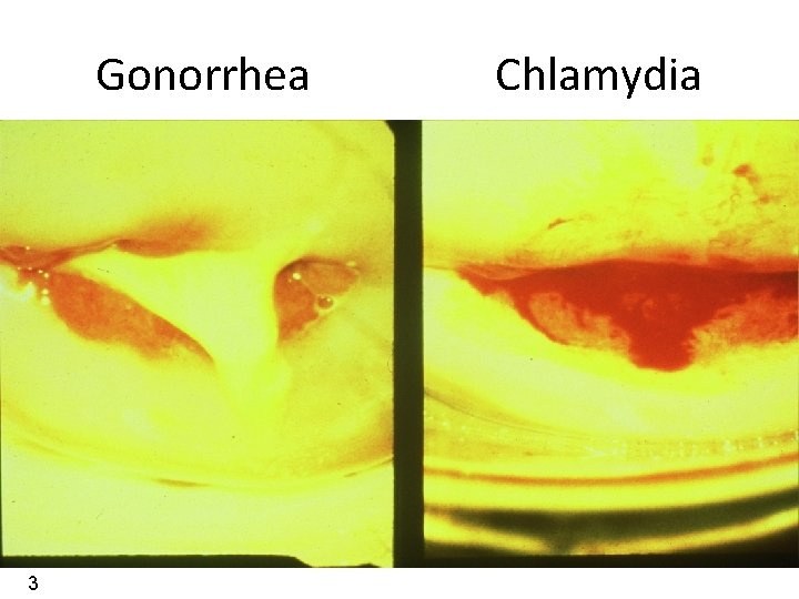Gonorrhea 3 Chlamydia 