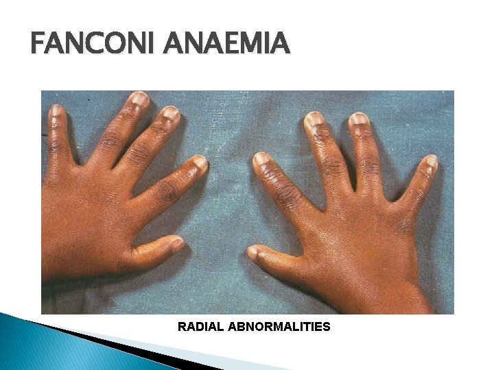 FANCONI ANAEMIA RADIAL ABNORMALITIES 