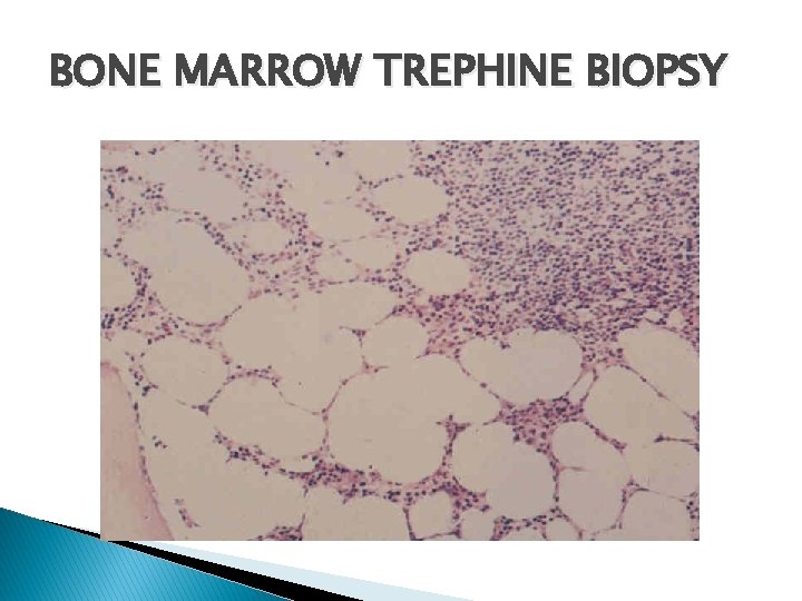 BONE MARROW TREPHINE BIOPSY 