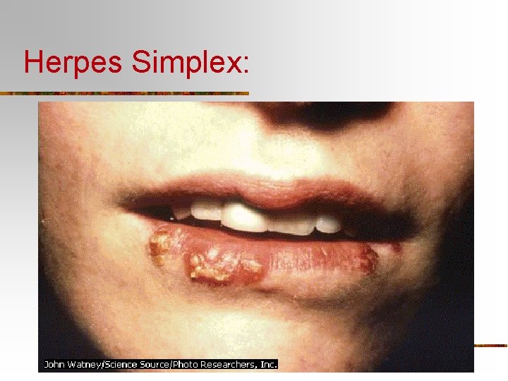 Herpes Simplex: 