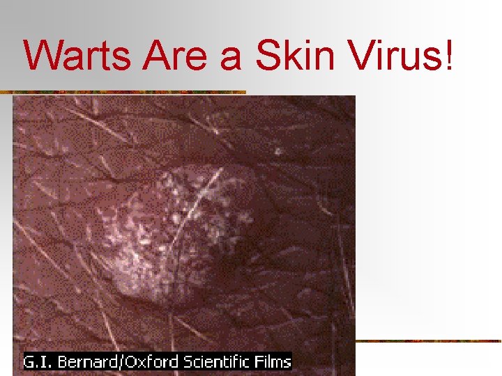 Warts Are a Skin Virus! 