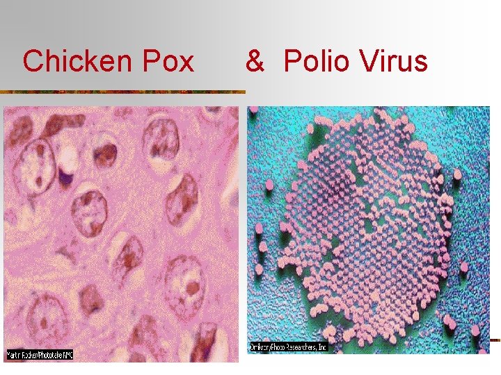 Chicken Pox & Polio Virus 