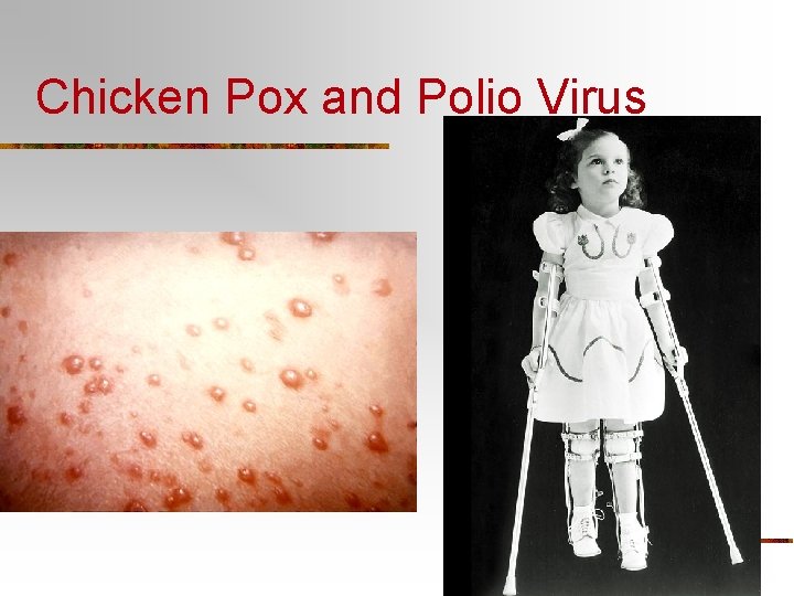 Chicken Pox and Polio Virus 