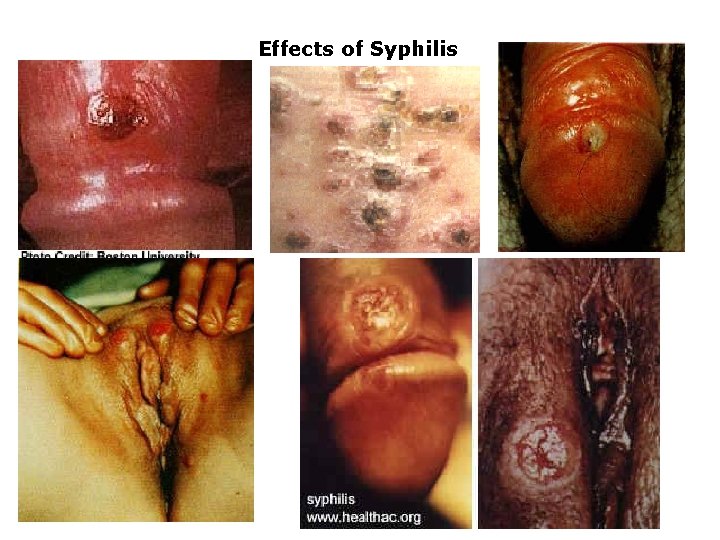 Effects of Syphilis 