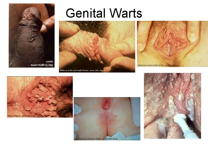 Genital Warts 