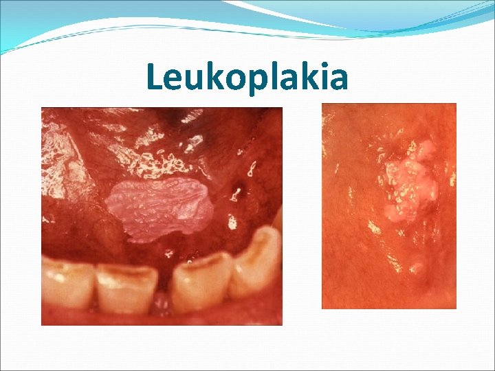 Leukoplakia 