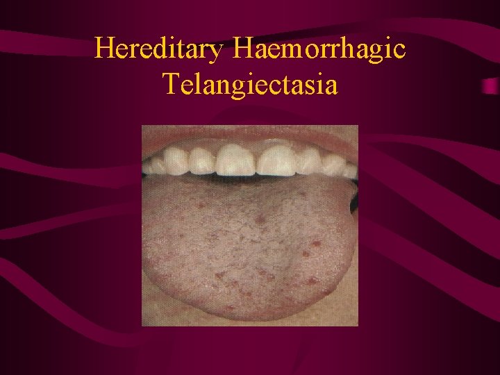Hereditary Haemorrhagic Telangiectasia 