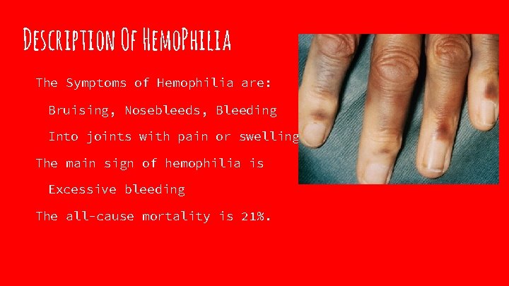 Description Of Hemo. Philia The Symptoms of Hemophilia are: Bruising, Nosebleeds, Bleeding Into joints