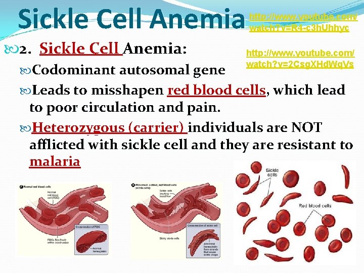 Sickle Cell Anemia 2. Sickle Cell Anemia: Codominant autosomal gene http: //www. youtube. com/