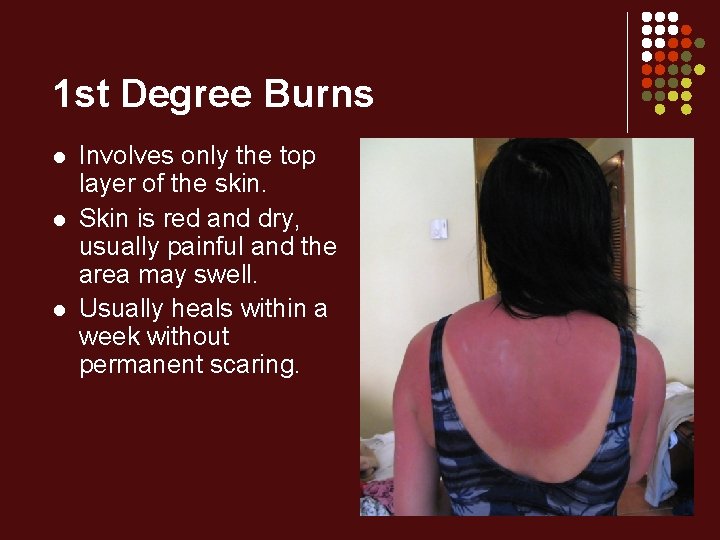 1 st Degree Burns l l l Involves only the top layer of the