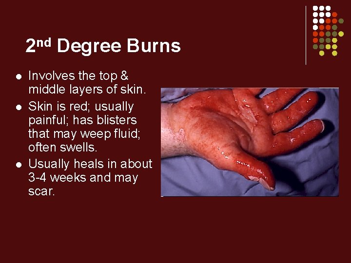 2 nd Degree Burns l l l Involves the top & middle layers of