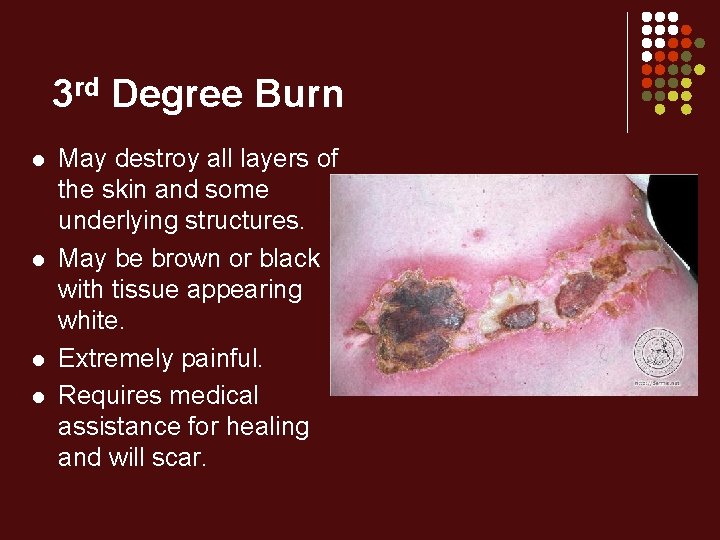 3 rd Degree Burn l l May destroy all layers of the skin and