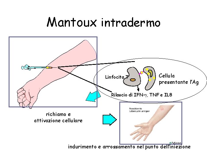 Mantoux intradermo Linfocita T Cellula presentante l’Ag Rilascio di IFN- , TNF e IL