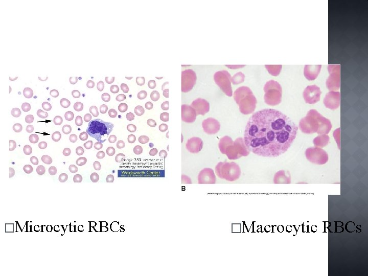 �Microcytic RBCs �Macrocytic RBCs 