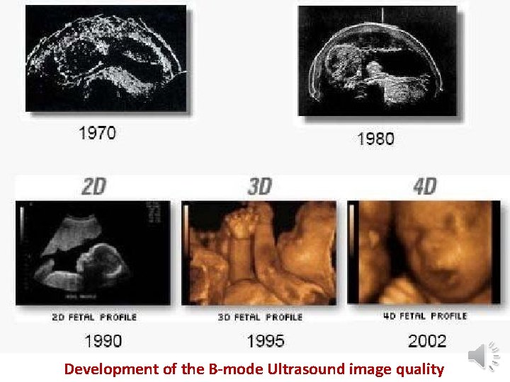 Development of the B-mode Ultrasound image quality 