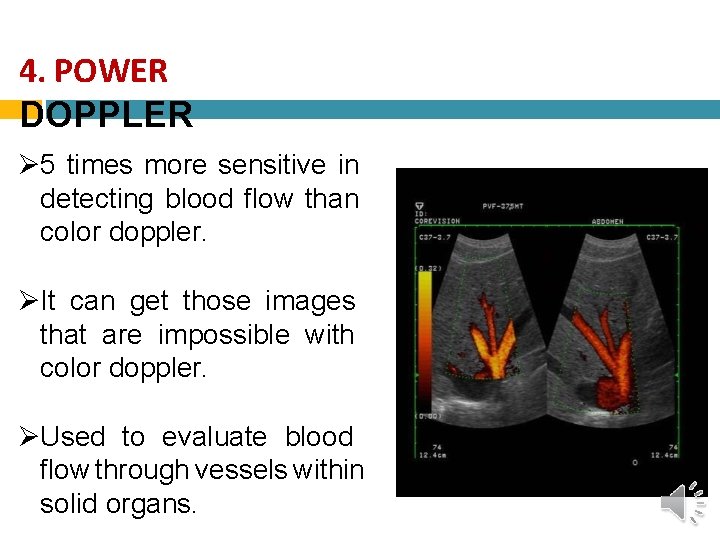 4. POWER DOPPLER 5 times more sensitive in detecting blood flow than color doppler.