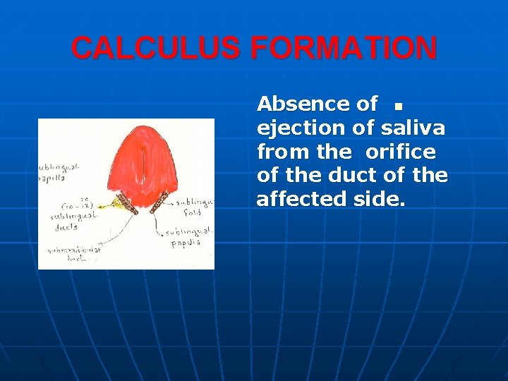 CALCULUS FORMATION Absence of n ejection of saliva from the orifice of the duct