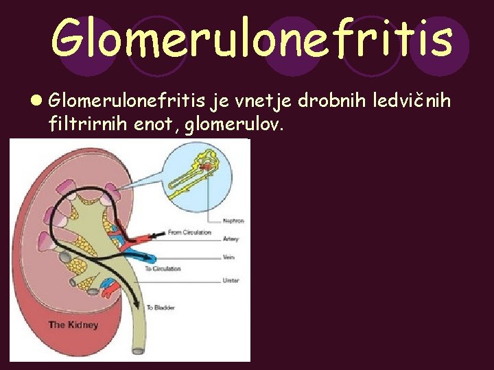 Glomerulonefritis l Glomerulonefritis je vnetje drobnih ledvičnih filtrirnih enot, glomerulov. 