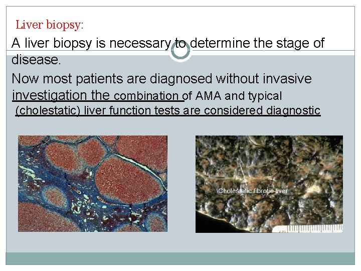 Liver biopsy: A liver biopsy is necessary to determine the stage of disease. Now