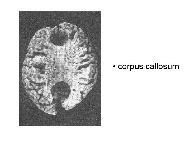  • corpus callosum 