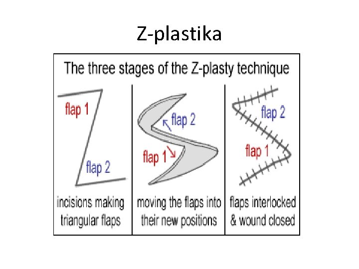 Z-plastika 