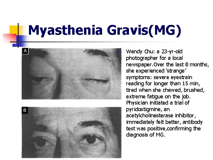 Myasthenia Gravis(MG) n Wendy Chu: a 23 -yr-old photographer for a local newspaper. Over