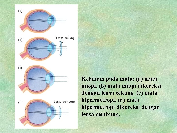 Kelainan pada mata: (a) mata miopi, (b) mata miopi dikoreksi dengan lensa cekung, (c)