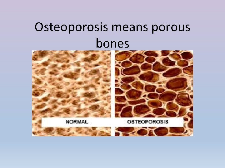 Osteoporosis means porous bones 