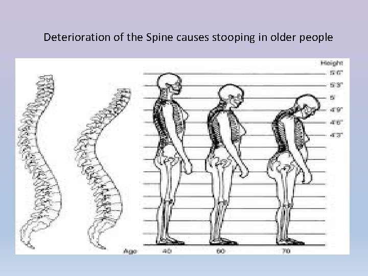 Deterioration of the Spine causes stooping in older people 