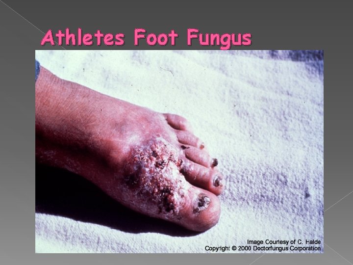 Athletes Foot Fungus 