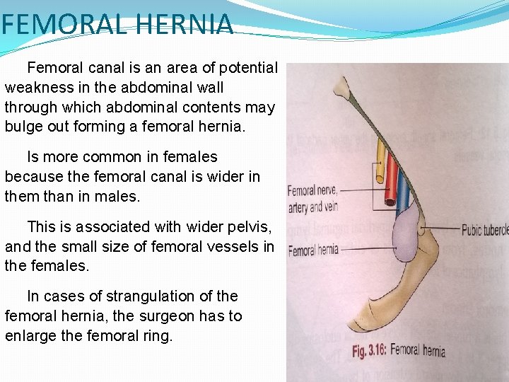 FEMORAL HERNIA Femoral canal is an area of potential weakness in the abdominal wall