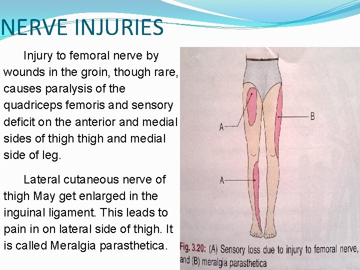 NERVE INJURIES Injury to femoral nerve by wounds in the groin, though rare, causes
