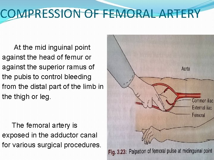 COMPRESSION OF FEMORAL ARTERY At the mid inguinal point against the head of femur