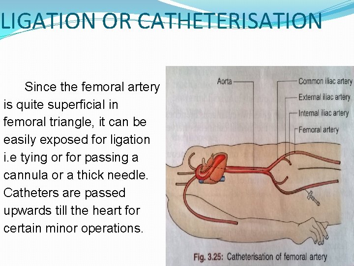 LIGATION OR CATHETERISATION Since the femoral artery is quite superficial in femoral triangle, it