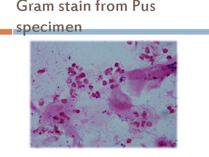 Gram stain from Pus specimen 