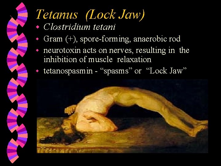 Tetanus (Lock Jaw) w Clostridium tetani Gram (+), spore-forming, anaerobic rod w neurotoxin acts