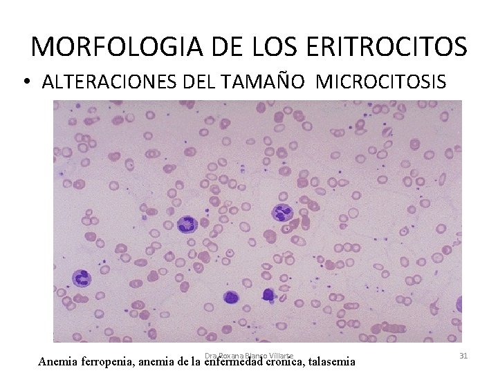 MORFOLOGIA DE LOS ERITROCITOS • ALTERACIONES DEL TAMAÑO MICROCITOSIS Dra Roxana Blanco Villarte Anemia