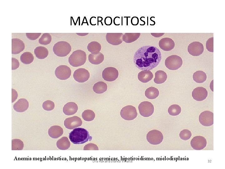 MACROCITOSIS Anemia megaloblastica, hepatopatias cronicas, hipotiroidismo, mielodisplasia Dra Roxana Blanco Villarte 32 
