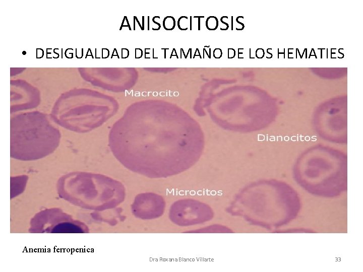 ANISOCITOSIS • DESIGUALDAD DEL TAMAÑO DE LOS HEMATIES Anemia ferropenica Dra Roxana Blanco Villarte