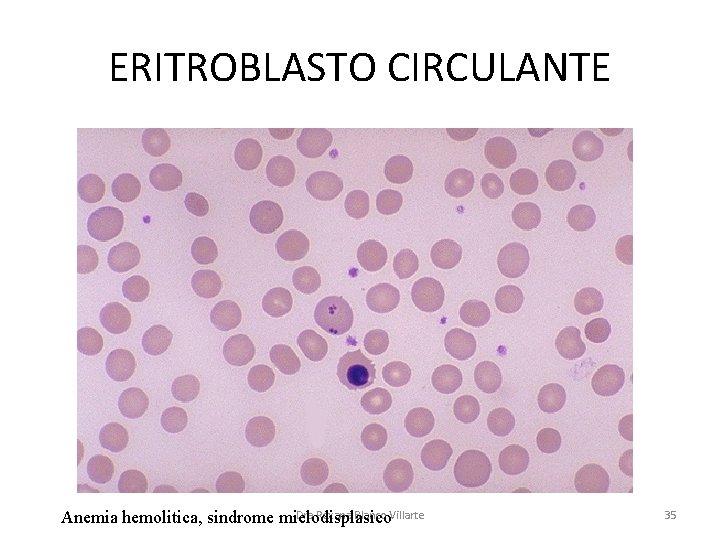 ERITROBLASTO CIRCULANTE Dra Roxana Blanco Villarte Anemia hemolitica, sindrome mielodisplasico 35 