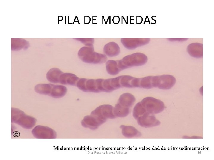 PILA DE MONEDAS Mieloma multiple por incremento de la velocidad de eritrosedimentacion Dra. Roxana